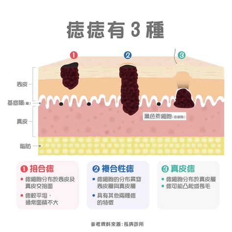 痣 凸起來|痣變大、痣多或長毛會變皮膚癌？認識痣的形成與原因